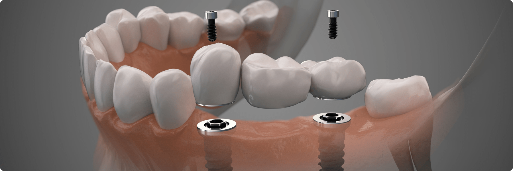 Dentiste Dr David Steuer implantologie Paris chirurgie dentaire